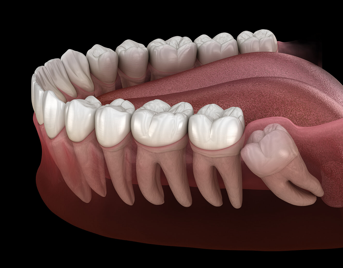 3rd Molar Extraction