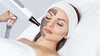 Carbon Laser Peel