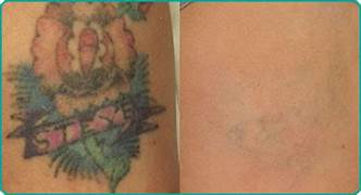 Color Tattoo Removal