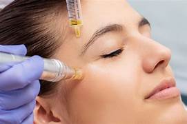 Micro Needling