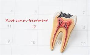 Root Canal Treatment