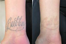 Tattoo Removal