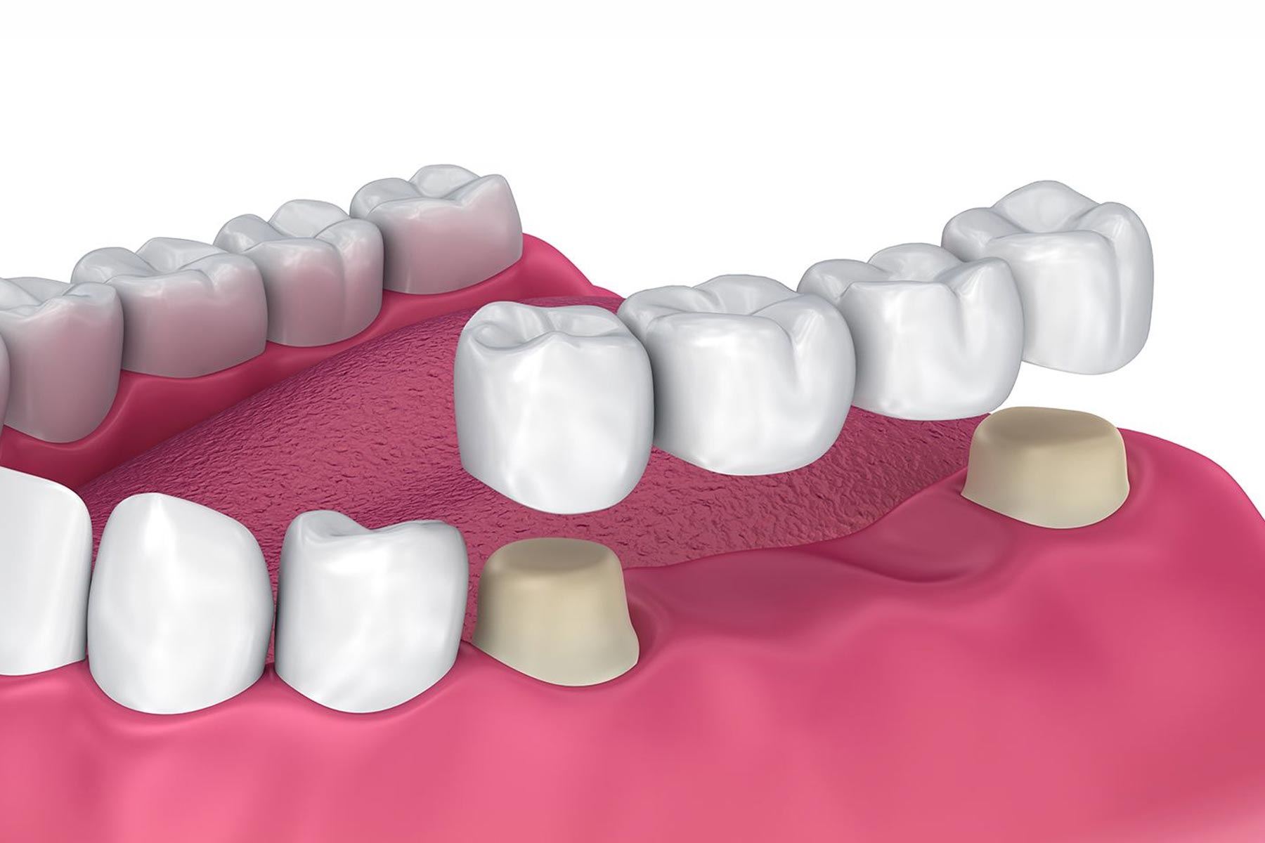 Dental Crown and Bridge