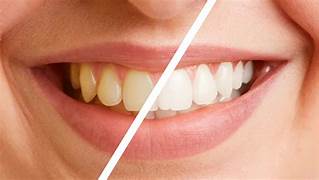 Dental Scaling and Polishing