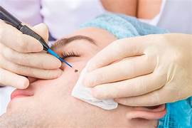 Warts Removal